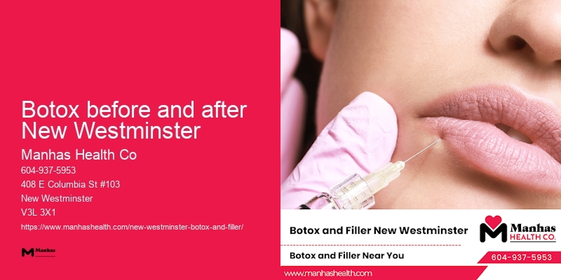 Botox for marionette lines Botox before and after New Westminster