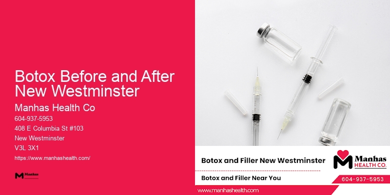 Precision Facial Rejuvenation Botox Before and After New Westminster